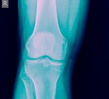 Knee x-ray of a 44 year old male patient front view by PhotoStock-Isra