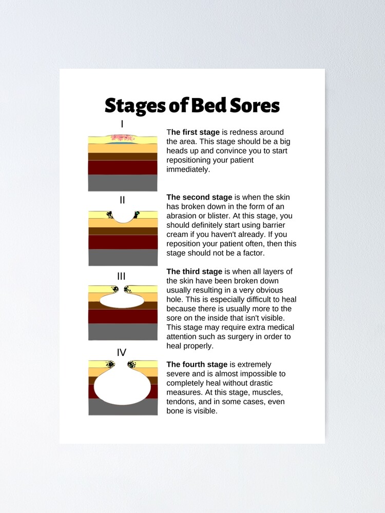 Stages Of Bed Sores Chart Poster For Sale By Caregiverology Redbubble