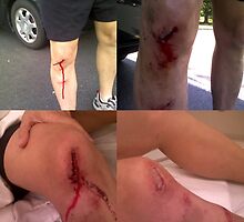 "rock, paper, knee" or "why cyclists shave their legs..." (not for the squeemish) by Ray Schloss