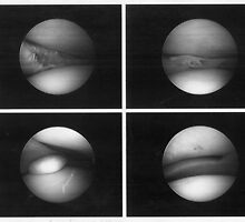 arthoscopic surgery photo of my knee by Anthony DiMichele