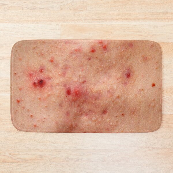Item preview, Acne skin damage, red blemish on chest designed and sold by Evan Sharboneau.