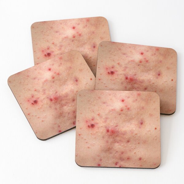 Item preview, Acne skin damage, red blemish on chest designed and sold by Evan Sharboneau.