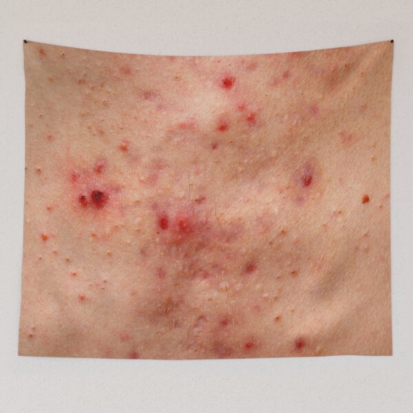 Item preview, Acne skin damage, red blemish on chest designed and sold by Evan Sharboneau.