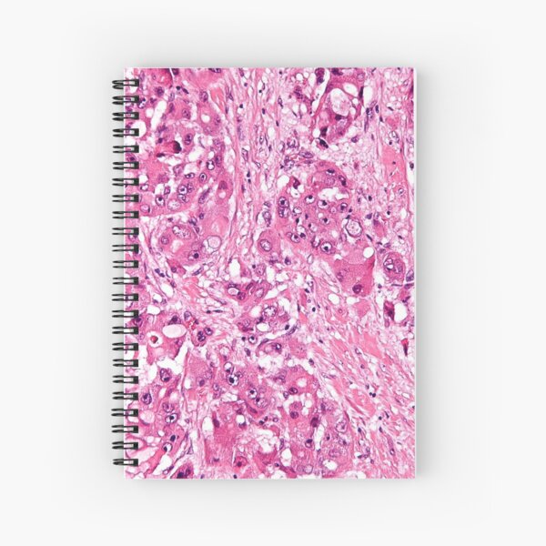 Liver Cancer Histology Spiral Notebook