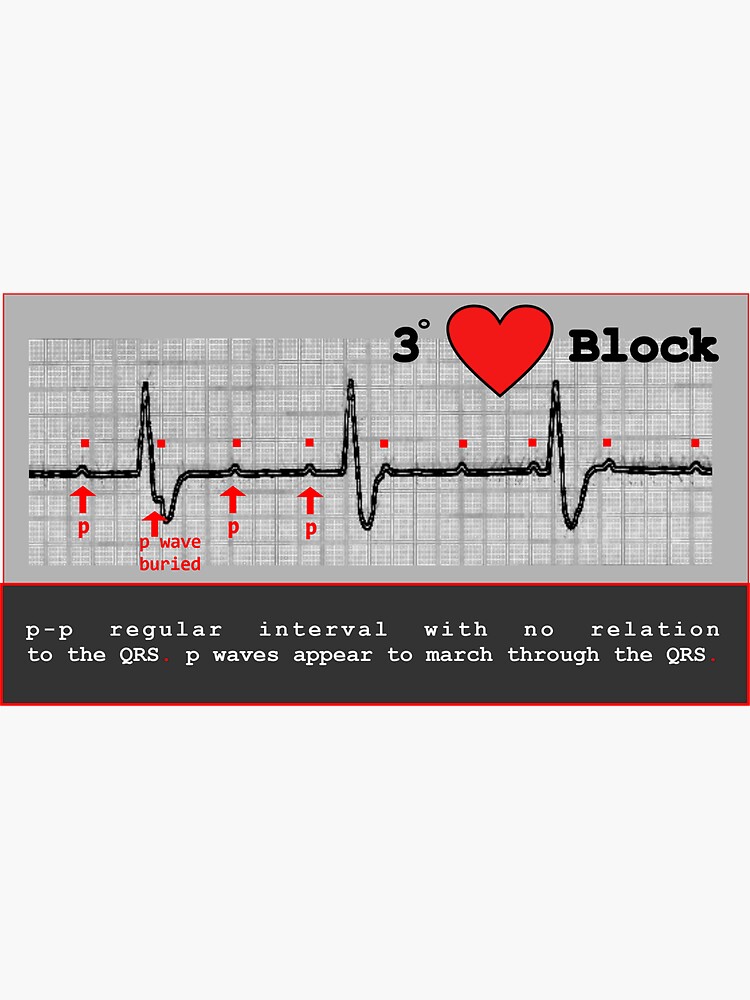 complete heart block Nursing Stickers by thesoupdate