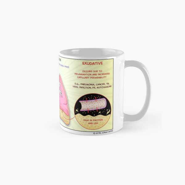 Pleural Effusions: Transudate vs. Exudate Classic Mug