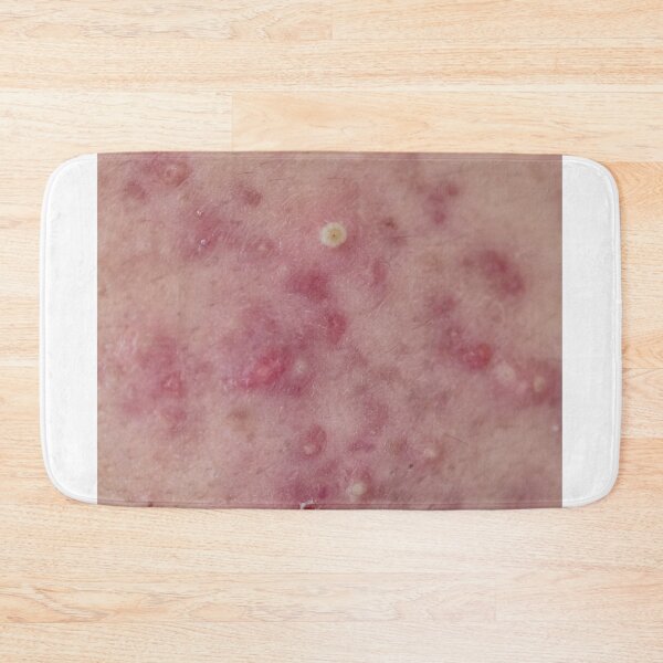 Item preview, Acne Skin designed and sold by freedom4life.