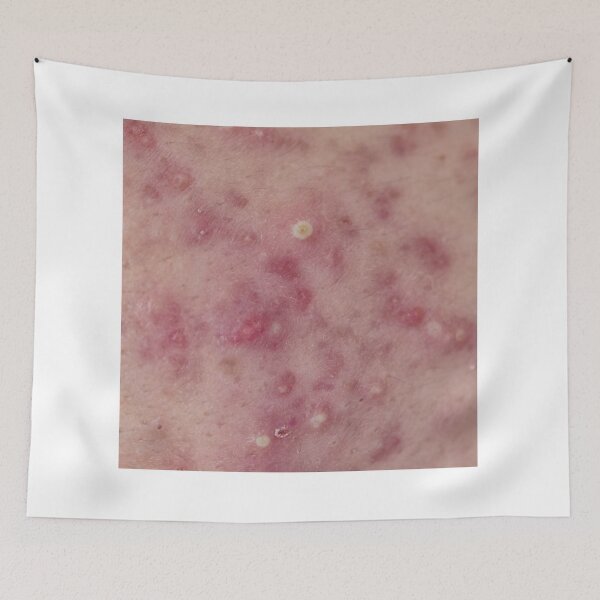 Item preview, Acne Skin designed and sold by freedom4life.