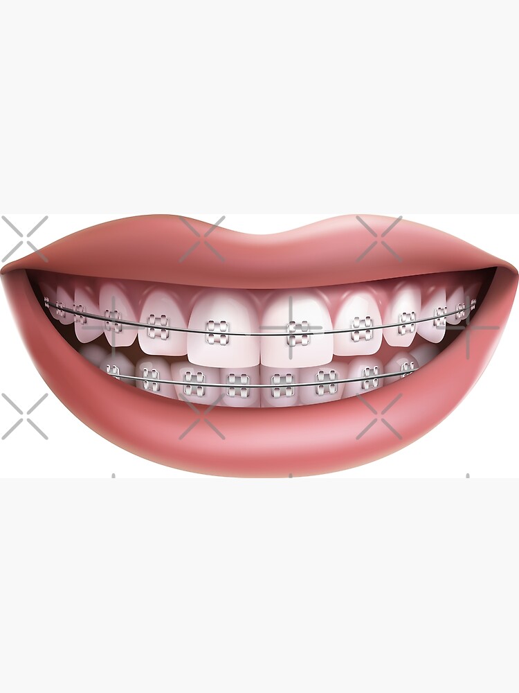 "orthodontic smile" Poster for Sale by neteor Redbubble