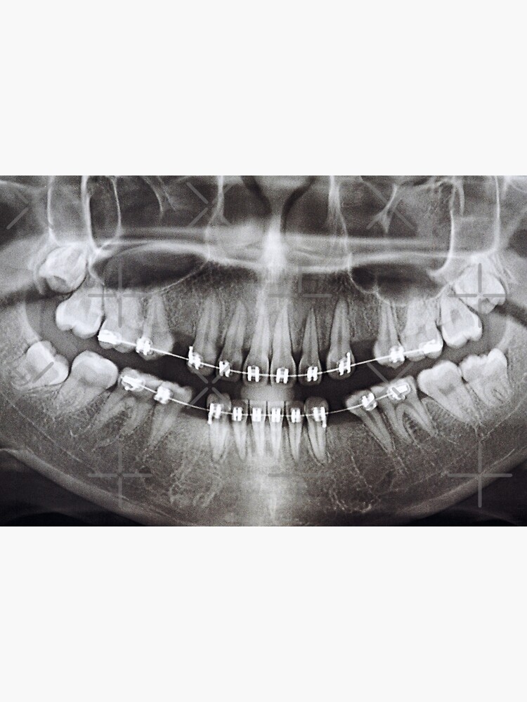 Impression photo for Sale avec l'œuvre « radiographie-dentaire ...