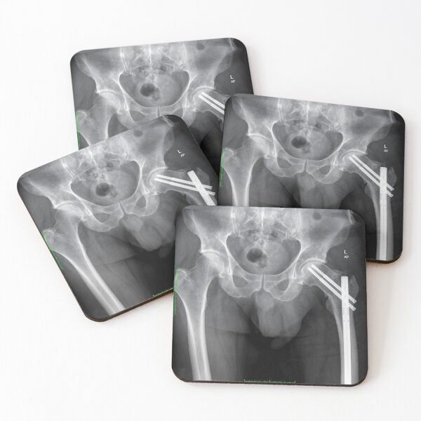 Item preview, Boneshmasher - x-ray with implant designed and sold by picturetom.