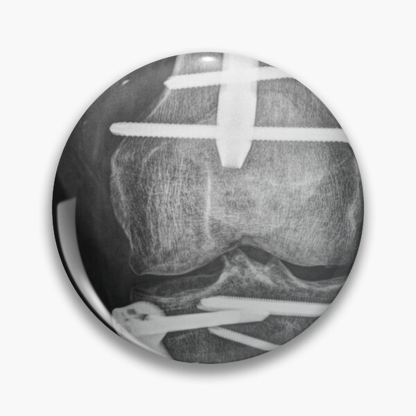 Item preview, Boneshmasher - x-ray with implants designed and sold by picturetom.