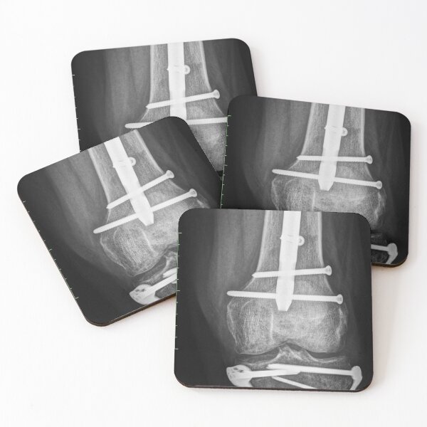 Item preview, Boneshmasher - x-ray with implants designed and sold by picturetom.