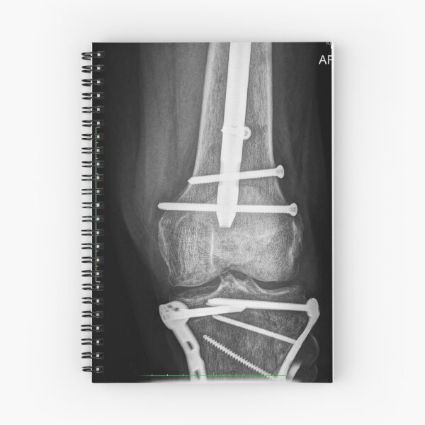 Item preview, Boneshmasher - x-ray with implants designed and sold by picturetom.