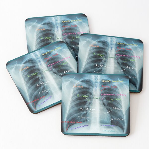 Item preview, Chest X-ray with labels designed and sold by TheWhiteRhyno.