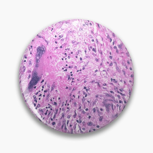 Item preview, Tuberculosis Histology designed and sold by deltoid.