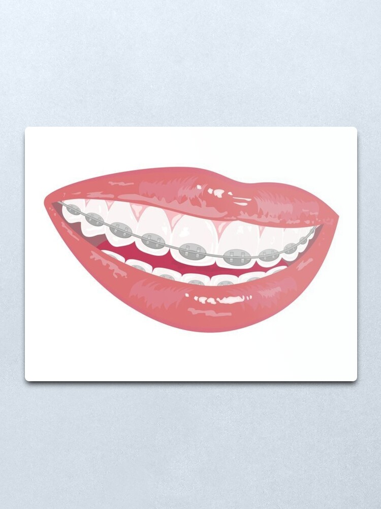 Braces Metal Print By Pipsta Redbubble - braces roblox free