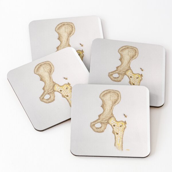 Item preview, Osteoporosis designed and sold by Aimee  Rondel.