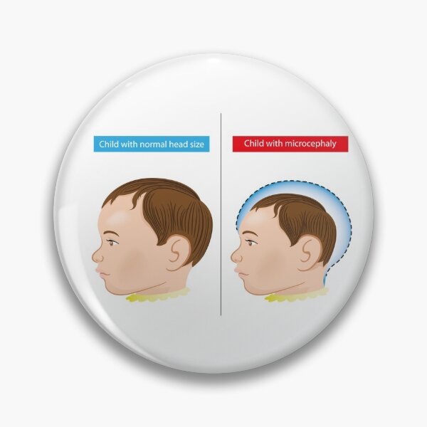 Item preview, Illustration of a newborn baby with microcephaly disease caused by Zika virus designed and sold by LucianoCosmo.