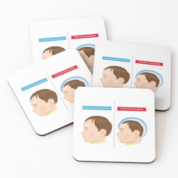Item preview, Illustration of a newborn baby with microcephaly disease caused by Zika virus designed and sold by LucianoCosmo.