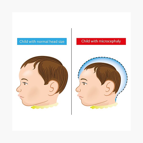 Lámina fotográfica «Ilustración de un bebé recién nacido con enfermedad ...