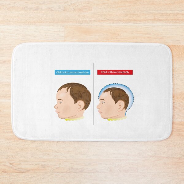 Item preview, Illustration of a newborn baby with microcephaly disease caused by Zika virus designed and sold by LucianoCosmo.