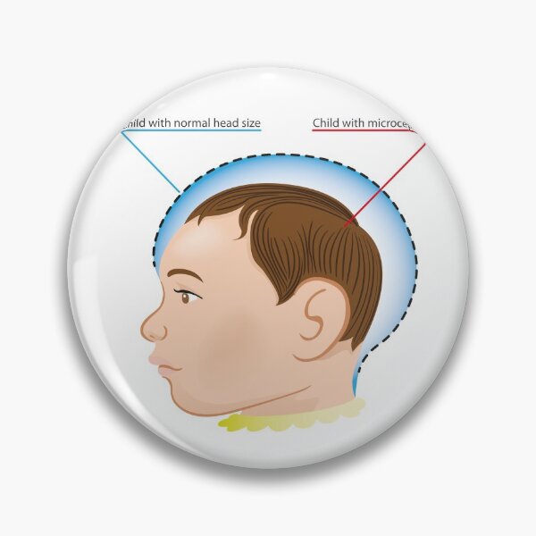 Item preview, illustration of a newborn baby with microcephaly disease designed and sold by LucianoCosmo.