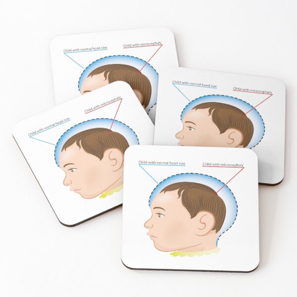Item preview, illustration of a newborn baby with microcephaly disease designed and sold by LucianoCosmo.