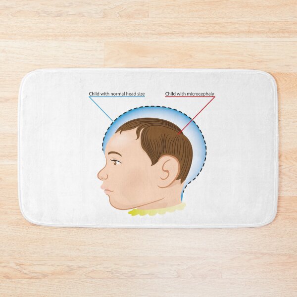 Item preview, illustration of a newborn baby with microcephaly disease designed and sold by LucianoCosmo.
