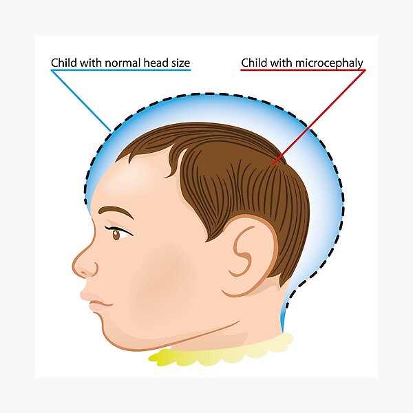 Lámina fotográfica «Ilustración de un bebé recién nacido con enfermedad ...