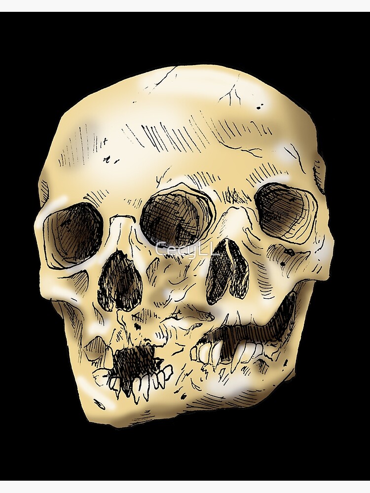 Double skull of Siamese twins