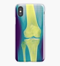 Knee x-ray front view iPhone Case