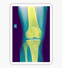 Knee x-ray front view Sticker