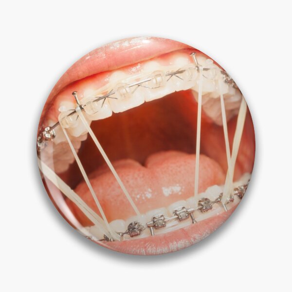 Item preview, Funny Open Mouth With Braces designed and sold by cgroenewald.