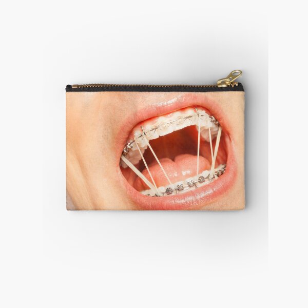 Item preview, Funny Open Mouth With Braces designed and sold by cgroenewald.