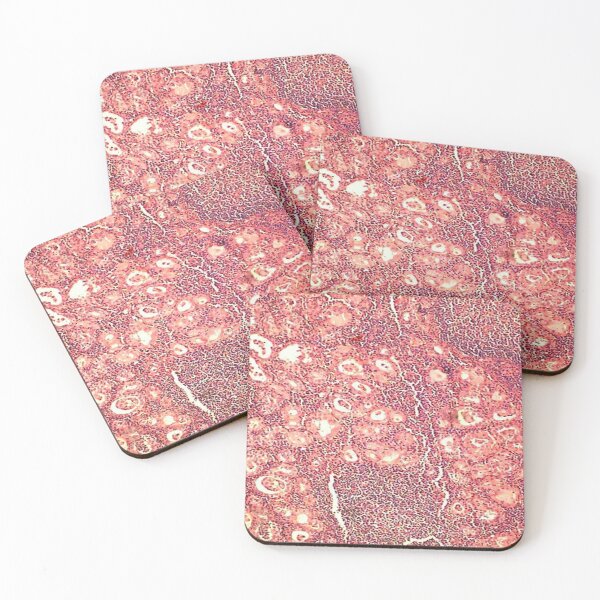 Item preview, Hashimoto's thyroiditis designed and sold by DarkiraVClemm.