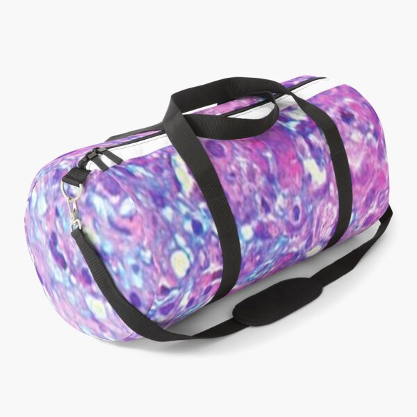 Item preview, Mucoepidermoid carcinoma designed and sold by DarkiraVClemm.