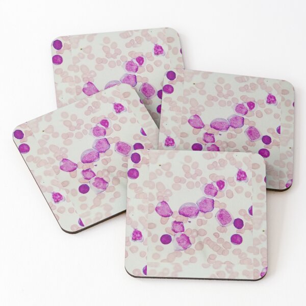 Item preview, Blast Cells and Anemia designed and sold by tasturm1.