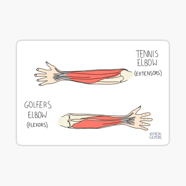 Tennis Elbow Sticker
