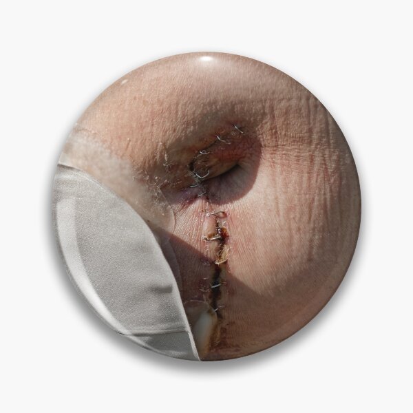 Item preview, stoma after bowel surgery  designed and sold by Claraveritas.