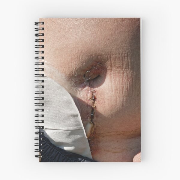 Item preview, stoma after bowel surgery  designed and sold by Claraveritas.