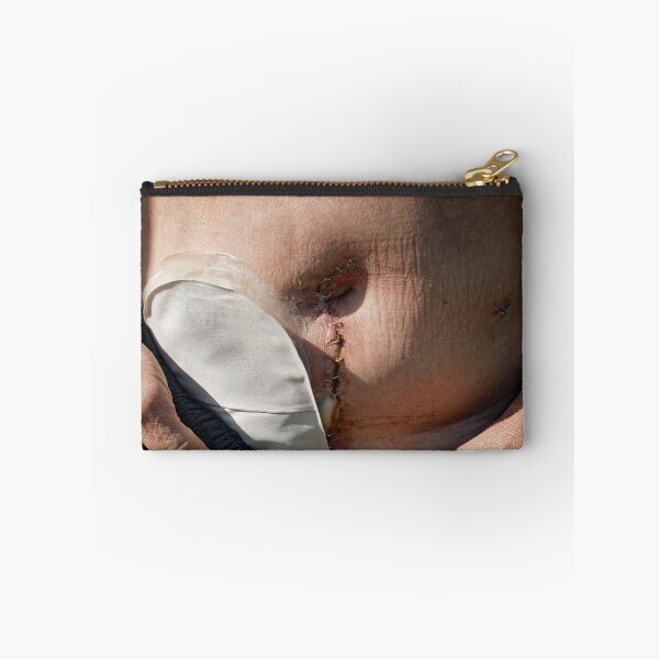Item preview, stoma after bowel surgery  designed and sold by Claraveritas.