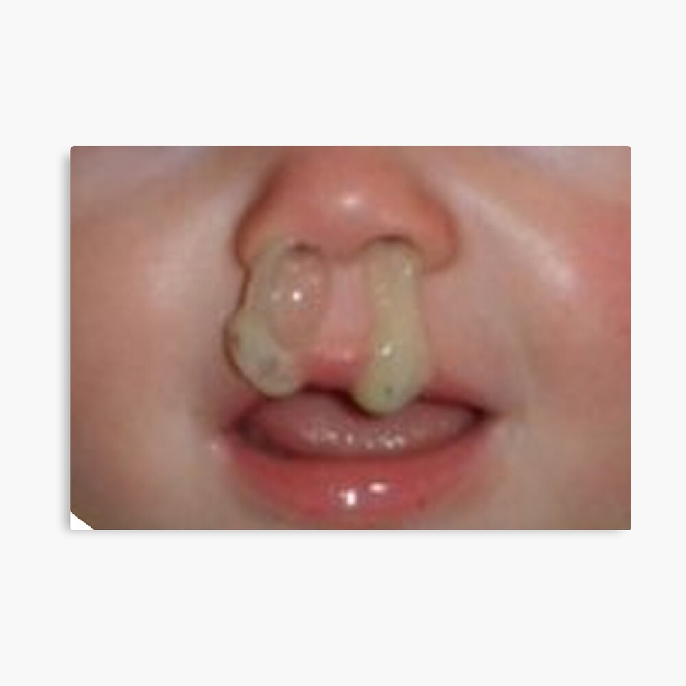 baby-runny-nose-6-remedies-to-soothe-a-baby-s-runny-nose