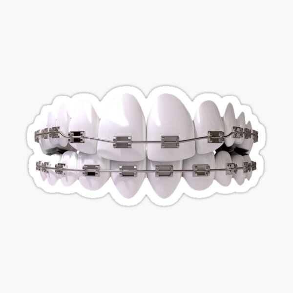 "white teeth with teeth brace, Dentistry Orthodontics Human tooth
