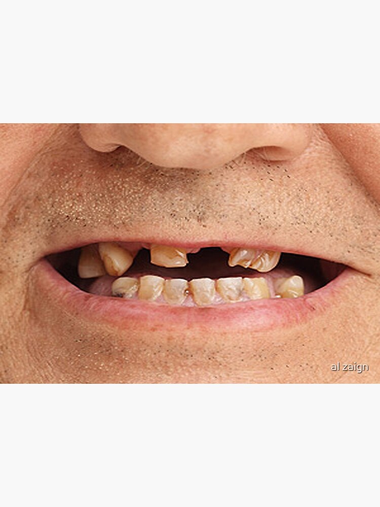 "Funny Missing Teeth Rotten smile face Mask" Mask for Sale by