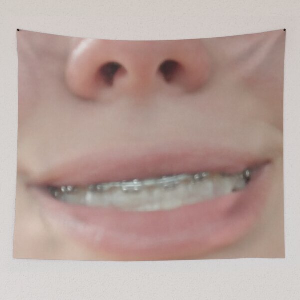 Item preview, Smile with Braces  designed and sold by IndyOnly.