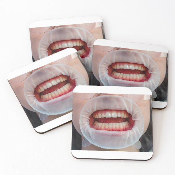 Item preview, Dentist's Cheek retractor designed and sold by More than Myriad.