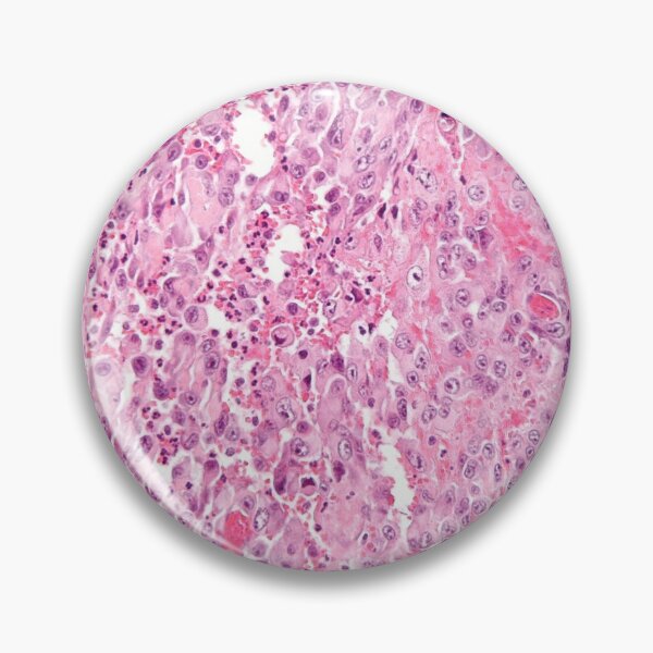 Item preview, Sarcoma Histology designed and sold by deltoid.