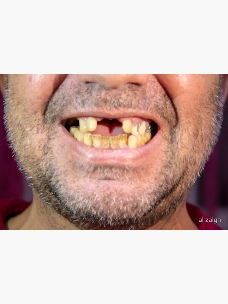 "Funny Missing Teeth funny smile face Mask" Mask for Sale by