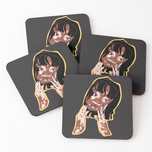 Item preview, Girl with vitiligo designed and sold by mccharmley.